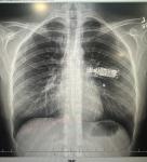 Посмотрите пожалуйста снимок рентгена грудной клетки фото 1