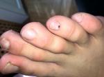 Пятно на ногте пальца ноги меланома или гематома? фото 1