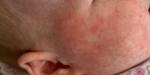 Воспалённые высыпания у ребёнка на лице/шее и груди фото 2