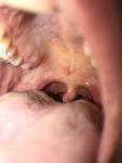 Белые пятна во рту (стоматит?) фото 1