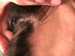 Сухость волосистой части головы у лба фото 1