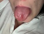 Воспаление на слизистой языка фото 1