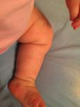 Красные шершавые пятна на ногах у ребёнка фото 3