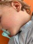 Сыпь у ребёнка после болезни фото 4