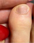 Продольная темная полоса на ногте-подногтевая меланома? фото 3