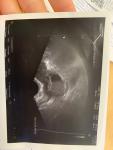 Кисты на яичнике, эндометриоз, беременность фото 3