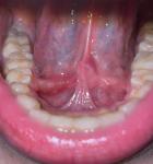 Воспаление под языком, воспаление слюной железы фото 1