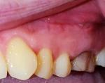 Белый налет после резекции корня зуба фото 1