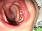 Белое пятнышко во рту у ребёнка фото 1
