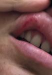 Сыпь на слизистой губы фото 1