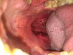 Опухла миндалина с одной стороны фото 3
