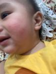 Покраснение и сыпь на щеках у ребёнка 10 месяца фото 2
