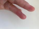 Зуд и трещины на пальцах рук фото 4