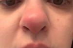 Воспаление носа фото 1