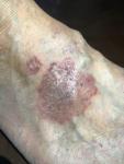 Растущие багровые пятна разъедающие кожу фото 2