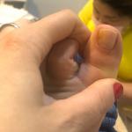Пятно и желтизна на ногте фото 2