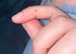 Чёрное пятно - точка под кожей на пальце руки фото 1