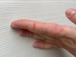 Трещины, зуд, шелушение кожи пальцев рук фото 5
