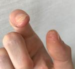Трещины на коже, утолщение под ногтями пальцев рук фото 2