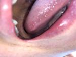 Болит сбоку язык и жжет фото 4