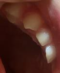 Желтый налет и клыки молочных зубов фото 1