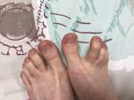 Пупырышки на больших пальцах ног около ногтей фото 1