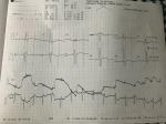 Плохая кардиограмма с нагрузкой фото 3