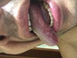 Лейкоплакия полости рта и губ фото 2