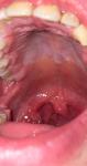 Красное горло и воспаление слизистой фото 1