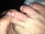 Появились красные точки на пальцах ног и болят фото 2