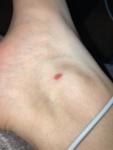 От чего могла появиться кровяная зудящая шишка на ноге? фото 1