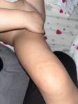 Сыпь у ребенка на ножках и животе фото 2