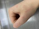 Сыпь на руке от пота, зуд фото 1