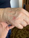 Появилась аллергия на руке фото 1