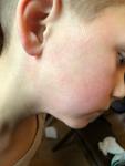 Сыпь у ребёнка на щеках и ушах фото 3
