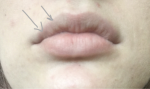 Увеличилась губа, ассиметрия фото 1