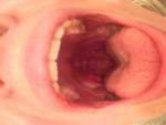 Шишка в горле, горло болит, на языке болят белые пупырышки фото 2