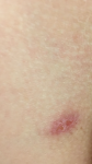 Красное пятно на теле с шелушением и болезненностью фото 1
