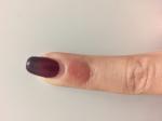 Красное шелушащееся пятном на указательном пальце фото 2