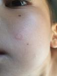 Кольцеобразное образование на щеке у мальчика 5 лет фото 1