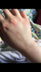 Шелушения на коже руки, жжение, пузырьки и покраснения фото 3