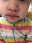 Сыпь вокруг рта у ребёнка фото 2