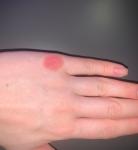 Красное пятно на костяшке руки фото 2