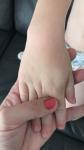 Пупырышки на руке у ребенка, чешутся фото 4