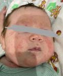 Аллергия, акне, новорожденный фото 2