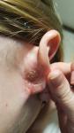 Корочки и мокнущие раны за ухом фото 1