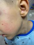 Странные пятна у ребёнка после отлеживания щеки фото 1