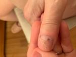 Темное пятно на ногте руки фото 2