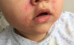 Сыпь вокруг рта у годовалого ребёнка фото 1