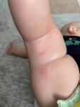 Шершавые красные пятна на ногах у ребёнка фото 1